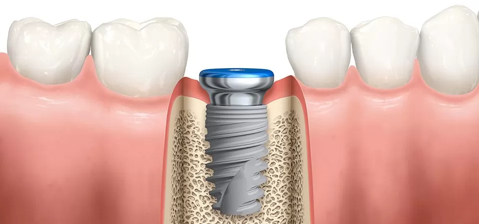 Возможности стоматологии возросли многократно при появлении имплантатов